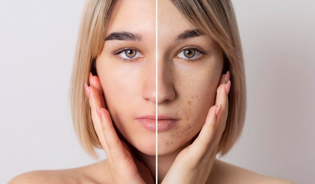 Anti Acne Treatment