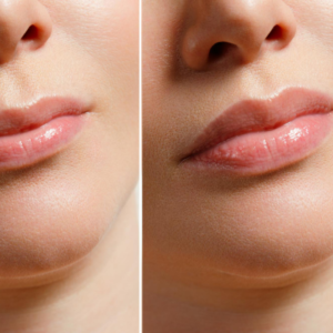 lip augmentation procedure for fuller lips at Aspire Aesthetics Nagpur
