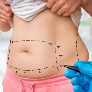liposuction procedure for body contouring in Nagpur at Aspire Aesthetics