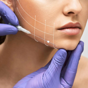 Thread lift treatment for facial lifting at Aspire Aesthetics in Nagpur