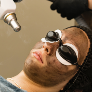 Carbon facial procedure for deep pore cleansing