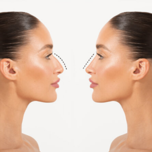 nose reshaping surgery rhinoplasty results